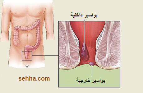 البواسير , اسبابها وطرق العلاج