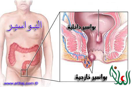 اعراض البواسير عند الرجال 20160722 438