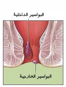 طريقة علاج بواسير متدلية