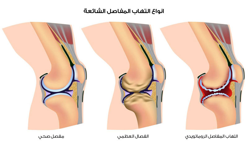 علاج الام المفاصل