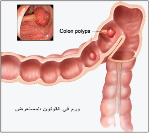علاج سرطان القولون 20160719 5279
