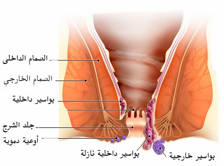 اعراض-مرض-البواسير-الداخليه-والخارجيه