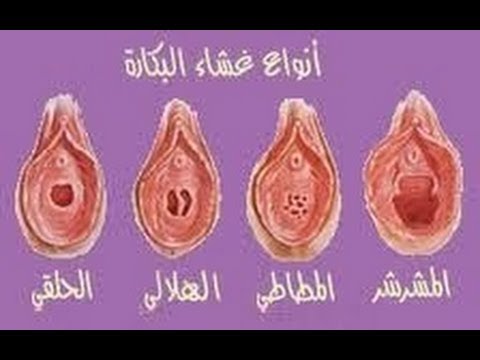 غشاء البكرة عند الفتاة بالصور الحقيقية 20160717 1780