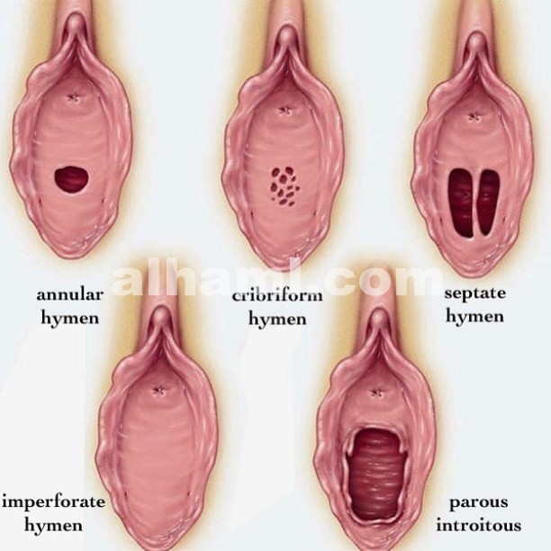 غشاء البكرة عند الفتاة بالصور الحقيقية 20160717 1783