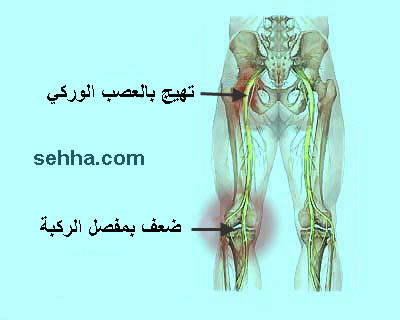 ماهو عرق النسا 21691 2