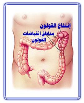 علاج ضيق التنفس بسبب القولون 20160715 86