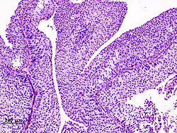 السرطان المثاتة مرض معدي 250Px Bladder Urothelial Carcinoma 1 Pt1