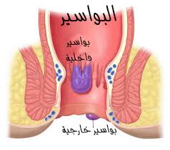 متى ظهر البواسير اول مرة 20160803 1761