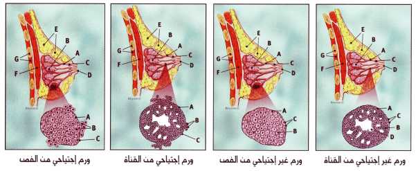 سرطان الثدى بالصور والتشخيص بالصور والعلاج والوقايه؟؟