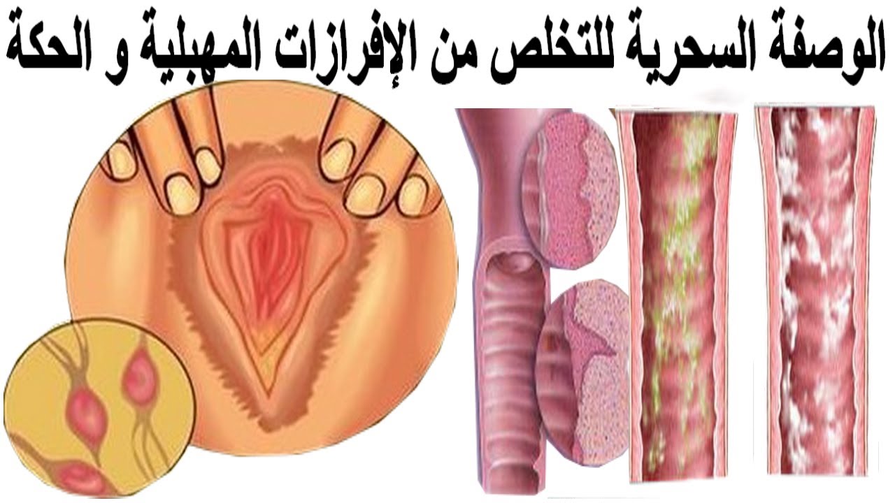 اسرع طريقة للتخلص من السيلان المهبلي 28959