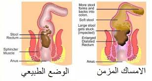 علاج للامساك المزمن والغازات 20160719 3819