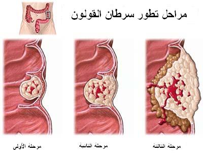 علاج سرطان القولون 20160719 5281