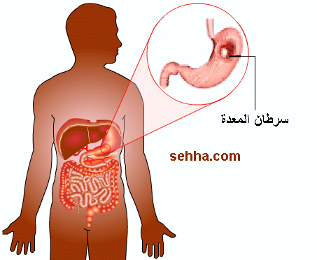 سرطان المعده Gastric Cancer