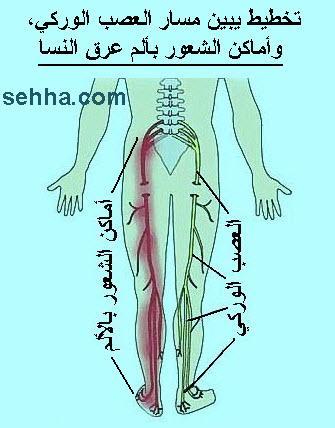 ماهو عرق النسا