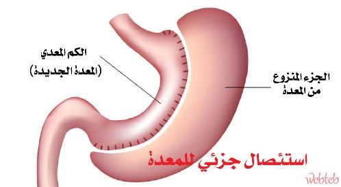 خطر سرطانات المعدة سرطان المعدة 31