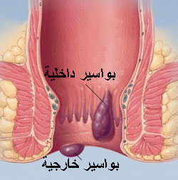 اسباب البواسير 20160730 511