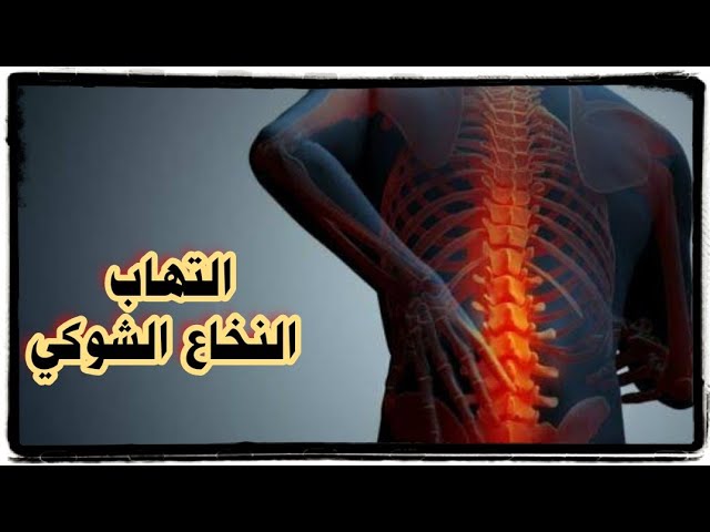 علاج التهاب النخاع الشوكي بالاعشاب الطبيعية ومدى خطورة هذا الاعتقاد , علاج طبيعي مضموض