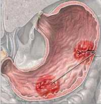 قرحة المعدة 16009 1