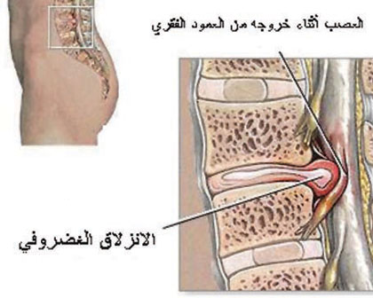 علاج الغضروف بدون جراحة 20160807 1178