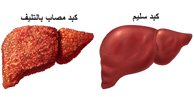 ماهي مضاعفات مرض الكبد على اعضاء الجسم