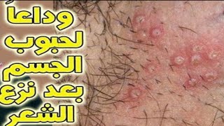 علاج الحبوب بعد ازالة الشعر من المناطق الحساسة , علاج آمن وصحي