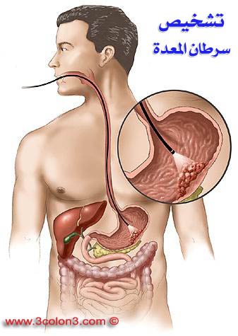 اعراض سرطان البطن 8756F6471266Fb37Ce1F0E0D64A86A70