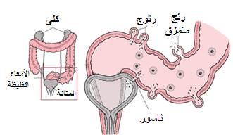 صعوبة في الاخراج من الناسور