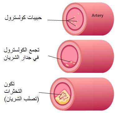 طريقة علاج الكوليسترول بطريقة سليمة 20160720 1705