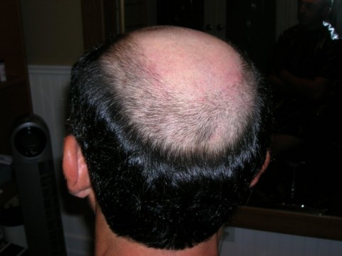 الجنسنج و علاج الصلع Male Pattern Baldness In Combination With Alopecia Areata