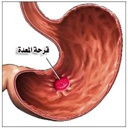 قرحة المعدة 16009 3