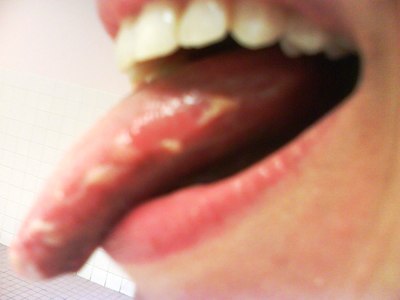 علاج حبة بالحلق Tongue