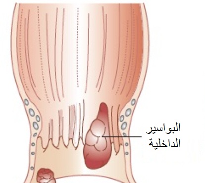 الفرق بين البواسير الخارجية والداخلية 20160725 1209