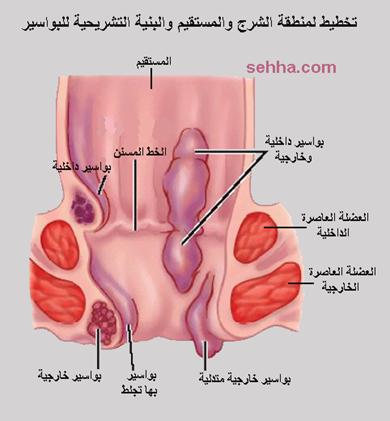 الفرق بين البواسير الخارجية والداخلية 20160725 1207