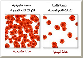 فقر الدم اسبابه وانواعه 68587