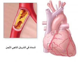الاعراض الواضحة لاصحاب مرض القلب 20160807 1265