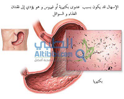 اعراض اعصاب المعدة - مرض القولون العصبي 17711 1