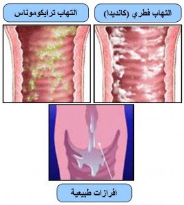 اسرع طريقة للتخلص من السيلان المهبلي 28959 2