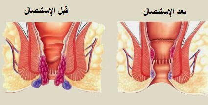 اسباب البواسير 20160730 513