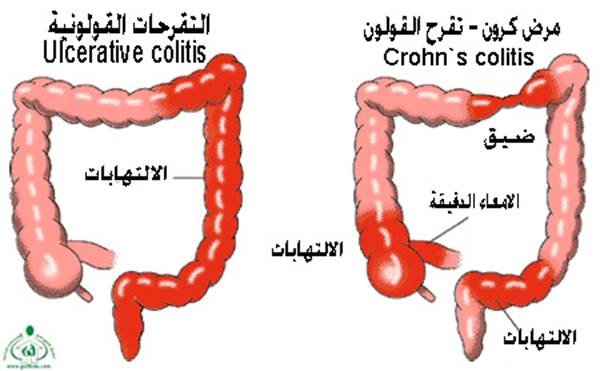 هبوط القولون 17159