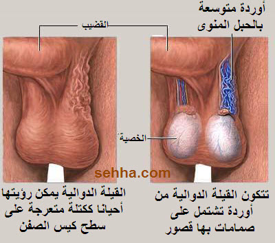 كيفية الكشف المنزلى على وجود دوالى الخصيتين - دوالي الخصية 17687