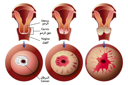 سرطان عنق الرحم 20160720 1679