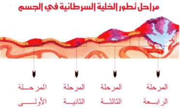 موضوع عن مرض السرطان