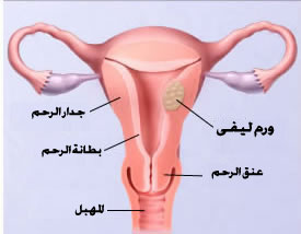 سرطان الرحم 15642 1