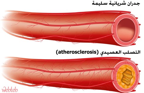 مضاعفات الكوليسترول