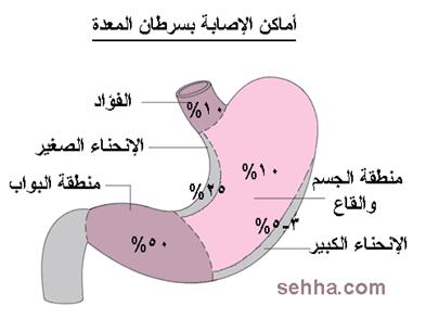 الام المعدة اول مرة اشوفها واعرف شائعتها - هل الام البطن من علامات السرطان 20160725 775