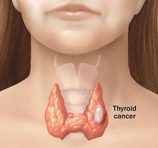 كيف تطور سرطان غدد في الجسم 20160807 1063