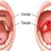 اعراض التهاب اللوز وطرق علاجها بالمنزل