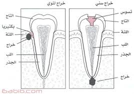 اضرار تسوس الاسنان - اسباب تسوس الاسنان 20160822 333