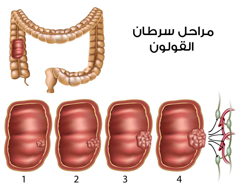 علاج سرطان القولون 20160719 5278