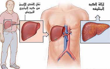 مرض الكبد 73A2D09E4C1Bc405C407515Fc22C6009